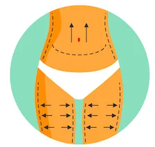 Abdominoplasty