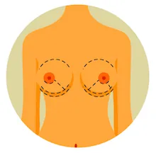 Breast Augmentation