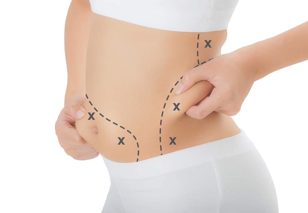 Best Gynaecomastia Surgeon in Bangalore