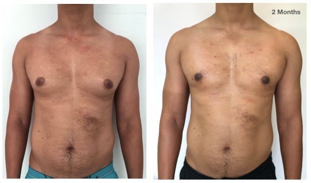 Best Gynaecomastia Surgeon in Bangalore