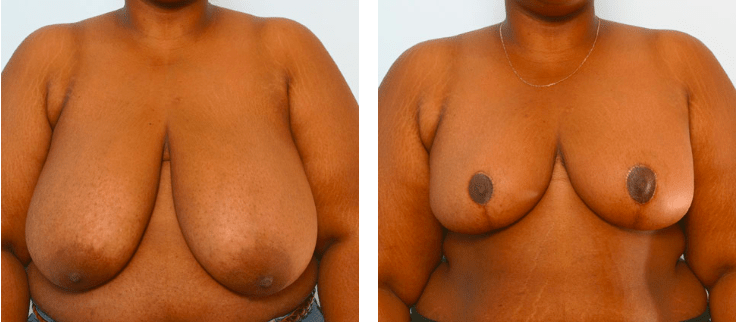 Best Gynecomastia Surgery Hospital in Bangalore