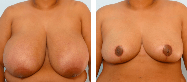 Best Gynecomastia Surgery Hospital in Bangalore
