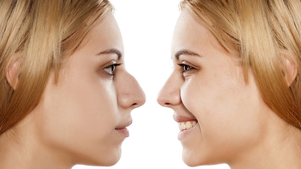 Best Nose Plastic Surgery, Rhinoplasty Surgery Hospital In Bangalore