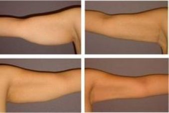 fractional laser resurfacing in bangalore