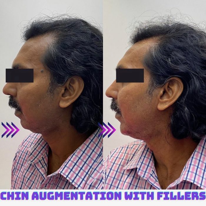 Juvederm for Chin Augmentation